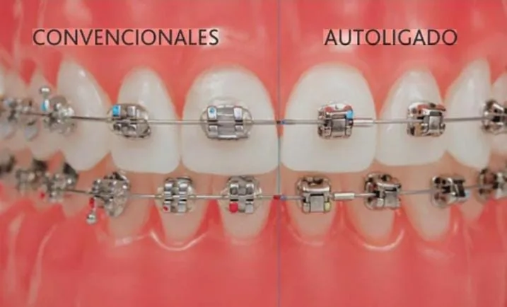 Comparación de brackets convencionales con ligas y brackets de autoligado