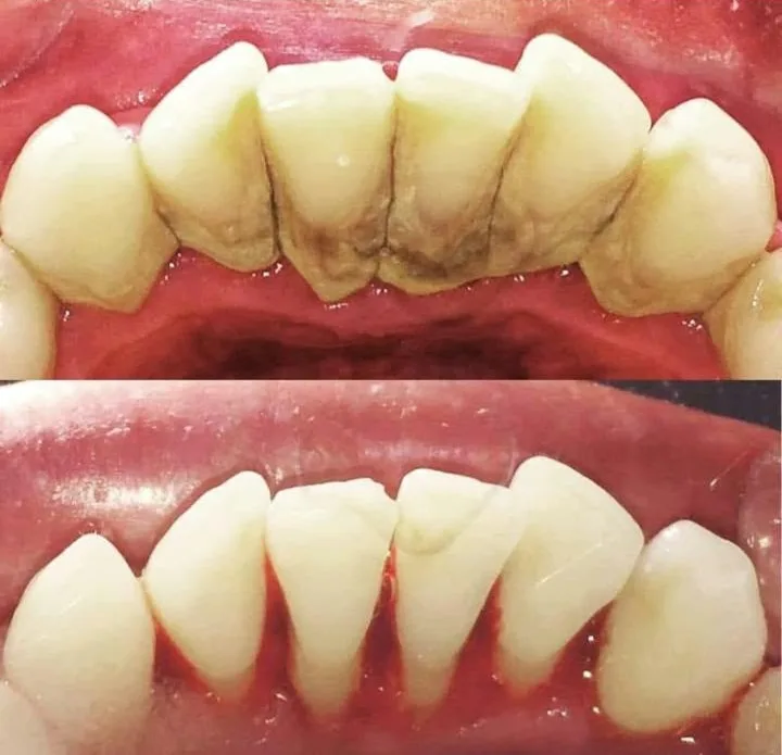Dientes inferiores con sarro antes de la limpieza (arriba) y limpios después de la profilaxis (abajo)